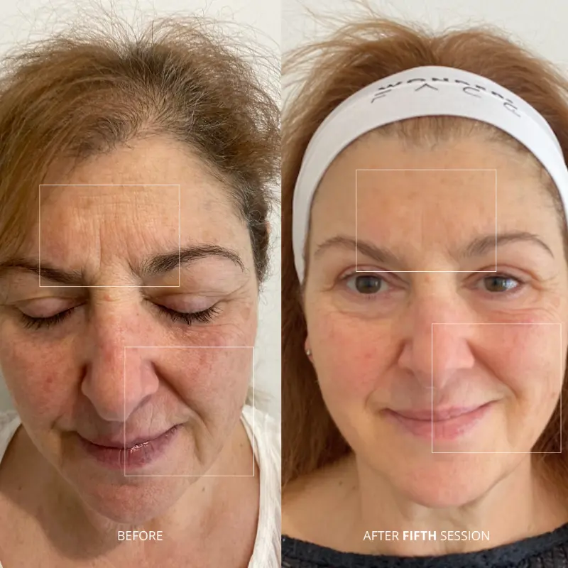 Forehead rejuvenation results