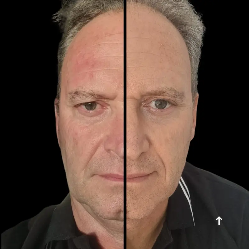 Overall facial rejuvenation results