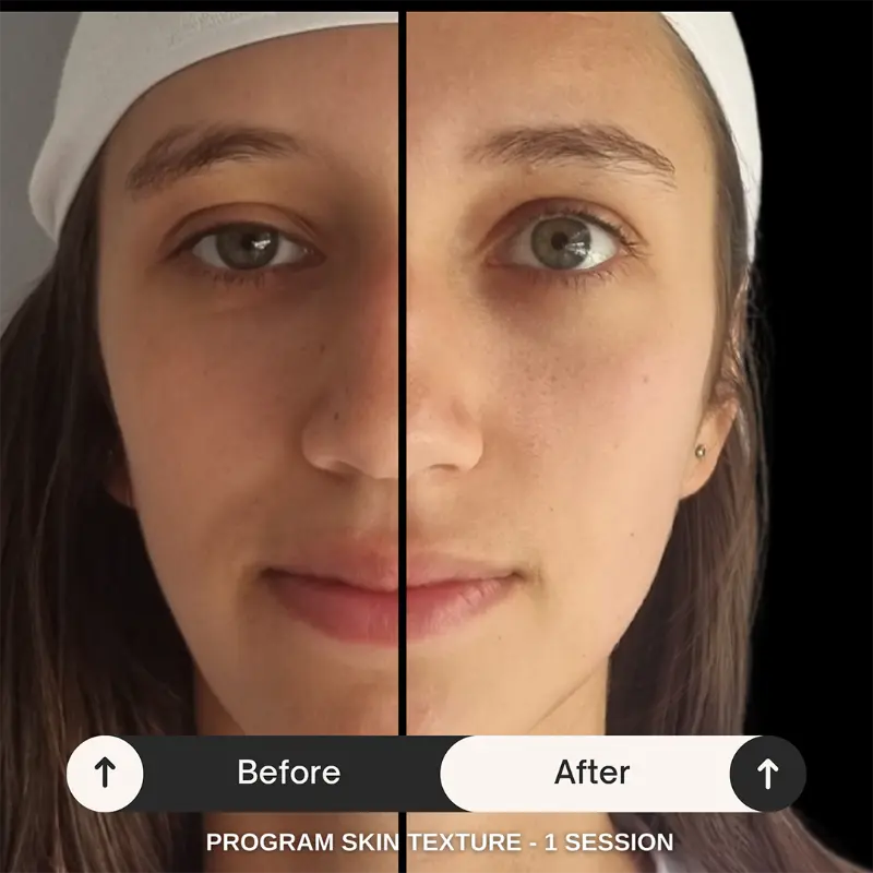 Skin texture and tone results